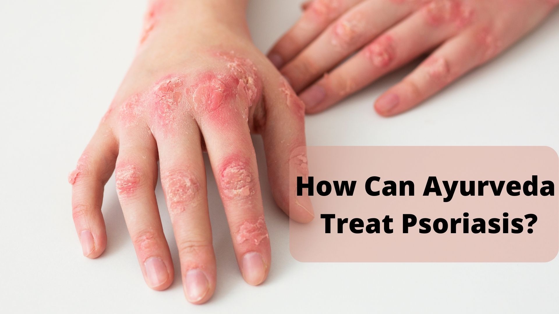 Sreesai Ayurvedics - Latest update - AYURVEDIC TREATMENTS FOR PSORIASIS AND SKIN DISEASES IN INDIRA NAGAR