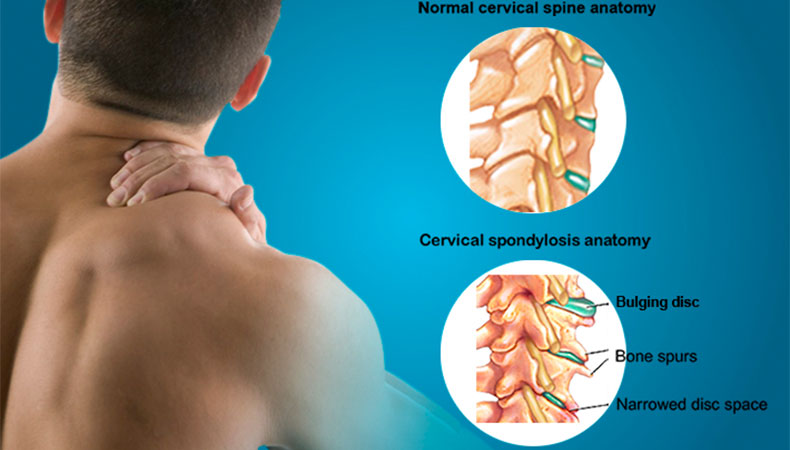 Sreesai Ayurvedics - Latest update - Cervical & Lumbar Spondylosis Treatment In Whitefield