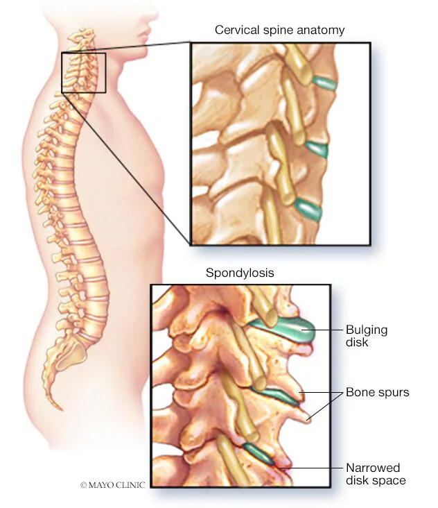 Sreesai Ayurvedics - Latest update - AYURVEDIC TREATMENTS FOR CERVICAL AND LUMBAR SPONDYLOSIS IN HORAMAVU