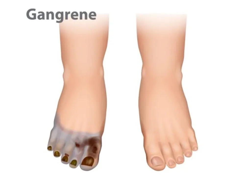 Sreesai Ayurvedics - Latest update - AYURVEDIC TREATMENTS FOR GANGRENE IN BANASWADI