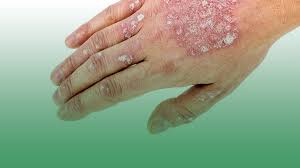 Sreesai Ayurvedics - Latest update - Psoriasis & Skin Diseases Services In Malleshwaram