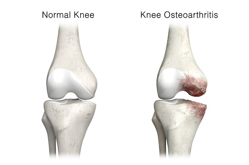 Sreesai Ayurvedics - Latest update - Best Ayurvedic Treatment For Osteoathritis Near  Kasturinagar